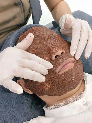 RIVIU SPA NẶN MỤN 99K DÀNH CHO HSSV CỰC KÌ CÓ TAAM ~~ - ảnh 1 riviu spa nan mun 99k danh cho hssv cuc ki co taam ~~ - anh 1