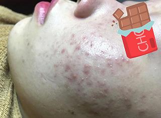HÀNH TRÌNH TRỊ MỤN GIAN NAN VÀ ĐIỂM ĐẾN CUỐI CÙNG CỦA MÌNH !!! - ảnh 3 hanh trinh tri mun gian nan va diem den cuoi cung cua minh !!! - anh 3