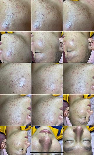 HÀNH TRÌNH TRỊ MỤN GIAN NAN VÀ ĐIỂM ĐẾN CUỐI CÙNG CỦA MÌNH !!! - ảnh 1 hanh trinh tri mun gian nan va diem den cuoi cung cua minh !!! - anh 1
